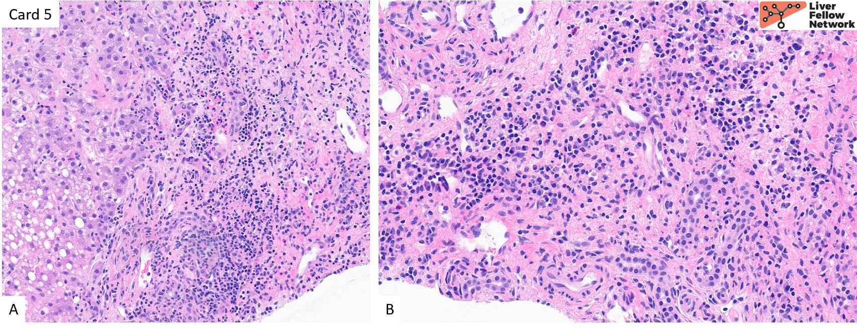 Liver Pathology | AASLD Liver Pathology | AASLD